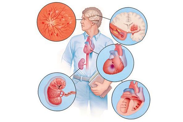 Dommages à divers organes souffrant d'hypertension artérielle prolongée